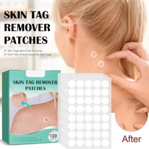 Parches para remover berrugas